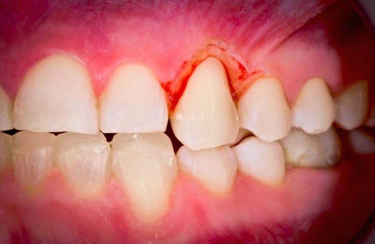 How To Spot The Signs Of Gum Disease - DemotiX