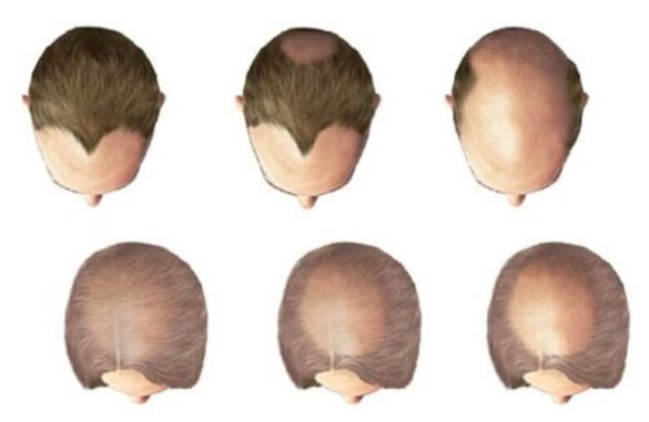 hair loss drugs