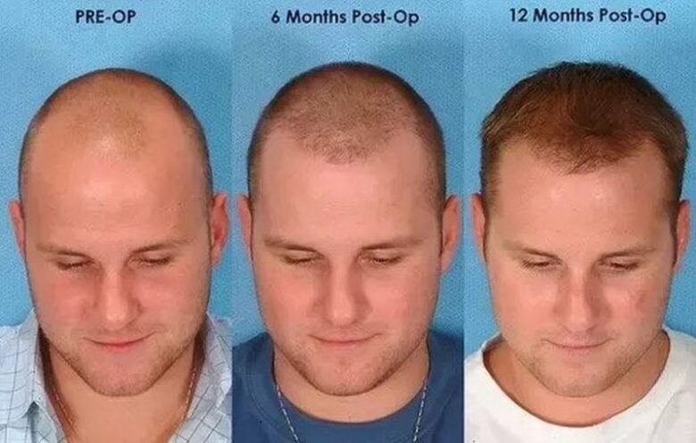 Hair Transplant: Everything You Need To Know About The Procedure