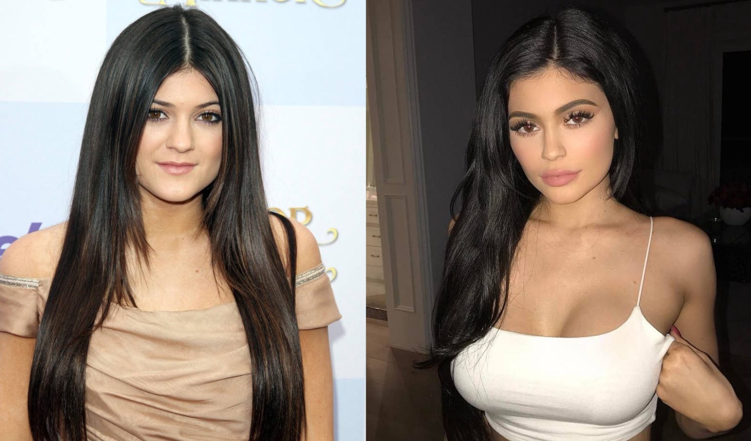 Kylie Jenner After & Before Pictures: Did She Do Surgery? 