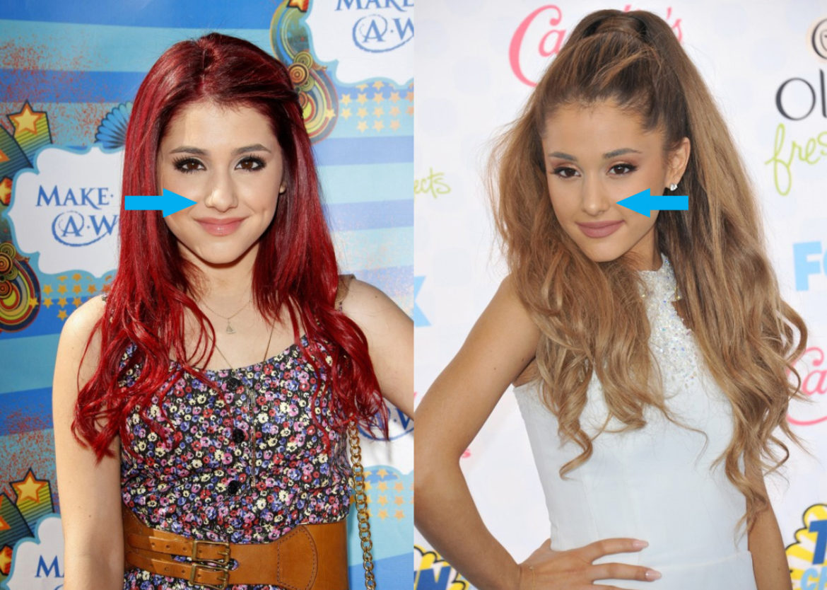 Ariana Grande Before & After The Power of Plastic Surgery! DemotiX