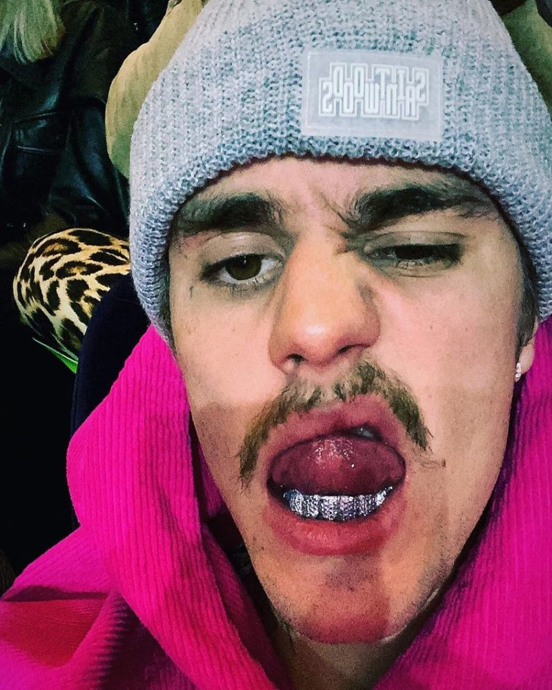Justin Bieber Looks Unrecognizable While Treating Lyme Disease