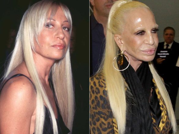 Is Donatella Versace The Biggest Celebrity Cosmetic Surgery Disaster Demotix