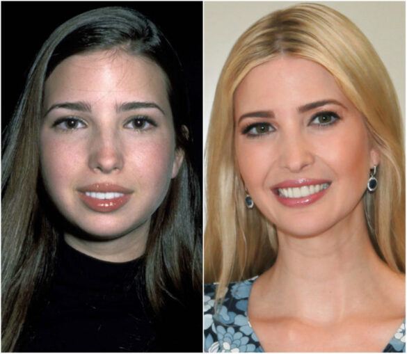 Before & After All Ivanka Trump’s Plastic Surgeries and Cosmetic