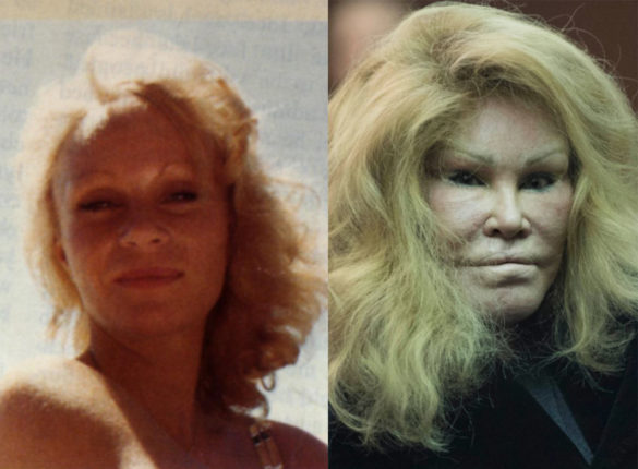 Jocelyn Wildenstein Cat Woman Plastic Surgery Before After My Xxx Hot