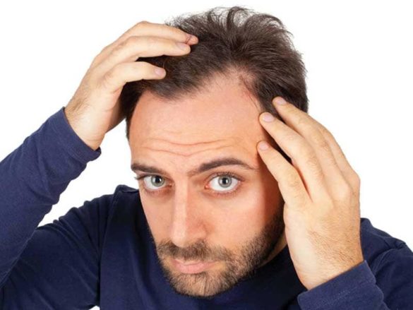 Early Signs Of Balding Causes Symptoms Tips And Treatment Options