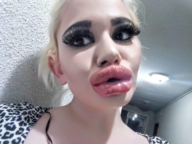 A Bulgarian Girl Had 17 Lip Augmentation Surgeries And Wants More 