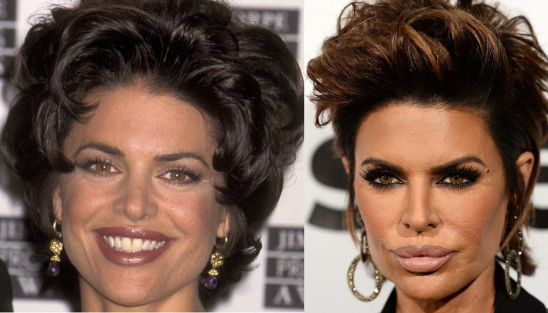 Lisa Rinna Plastic Surgery Before And After Lisa Rinna Plastic Surgery ...