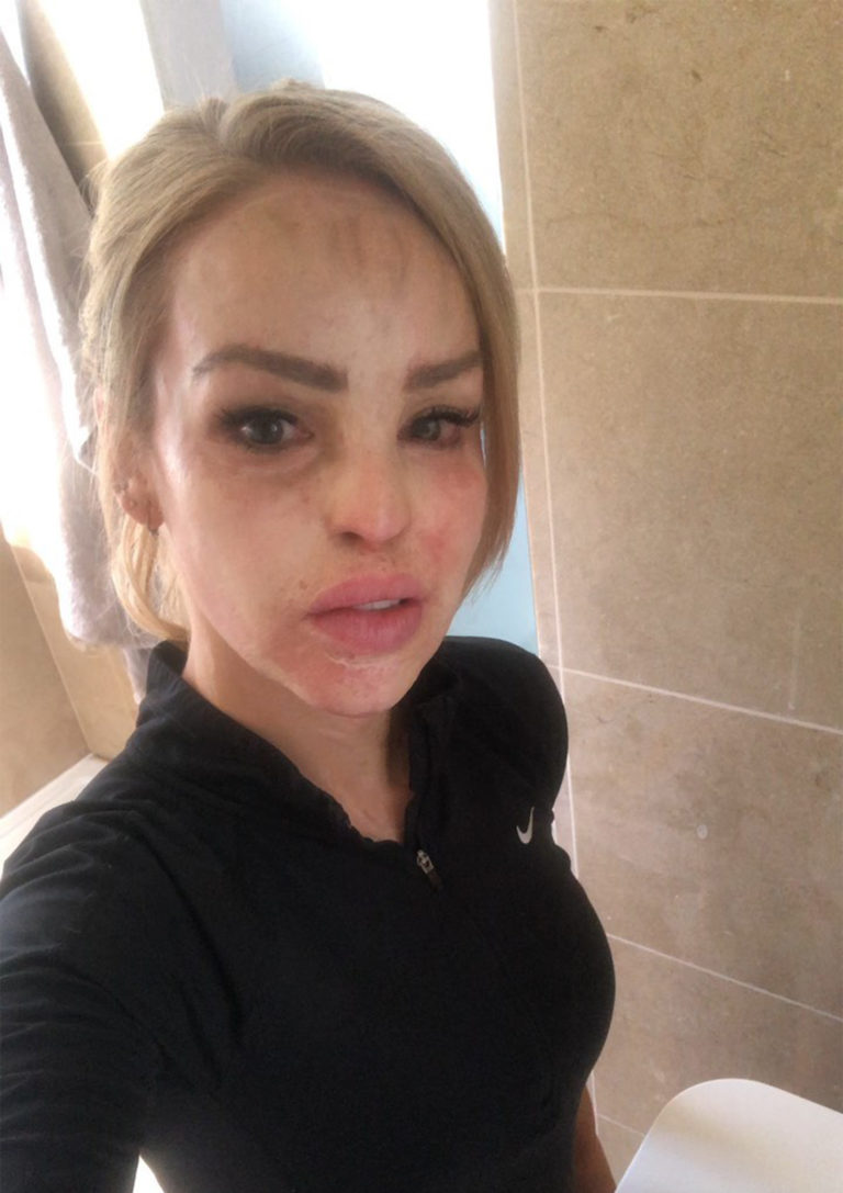 Katie Piper Fully Recovered After She Had Acid Thrown in Her Face