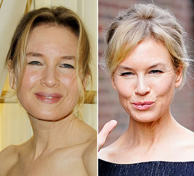 Renée Zellweger Turns 51: How Plastic Surgery Changed Her Look Over The 