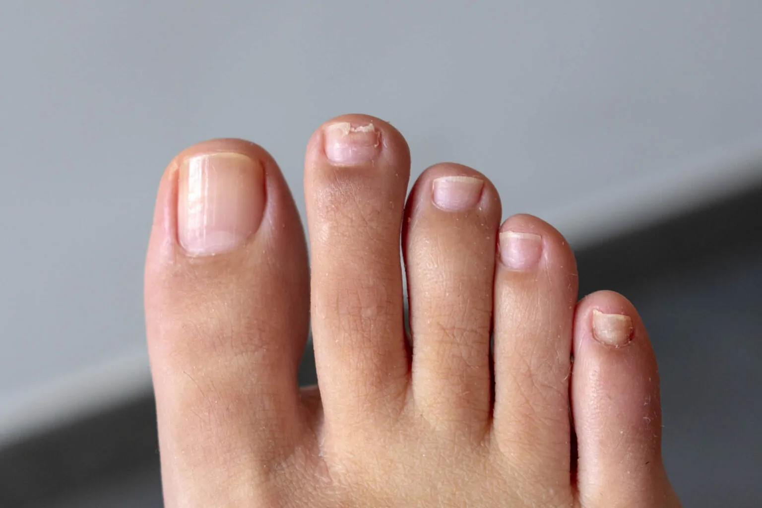 Nail Fungus Causes, Symptoms And Treatment 2024 Guide DemotiX