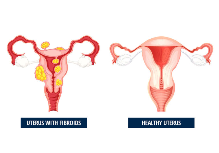 5 Causes Of Fibroids On Uterus And Its Treatment In 2024 DemotiX