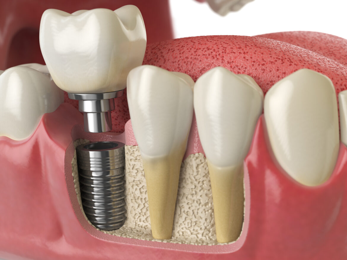 8 Reasons To Choose A Dental Implant Over Partial Dentures Demotix 