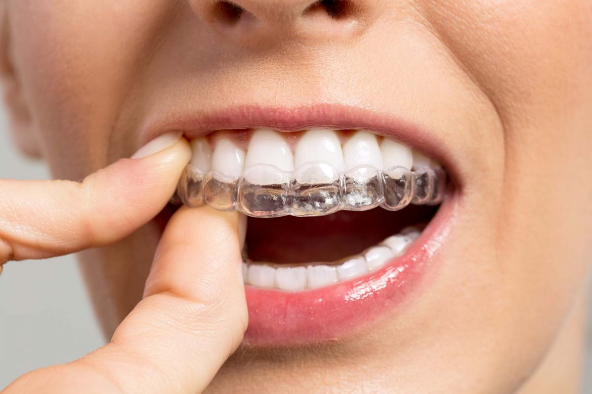 7 Alternatives to Braces 2024 Guide