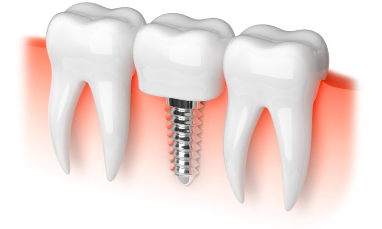 Dental Implants in Turkey