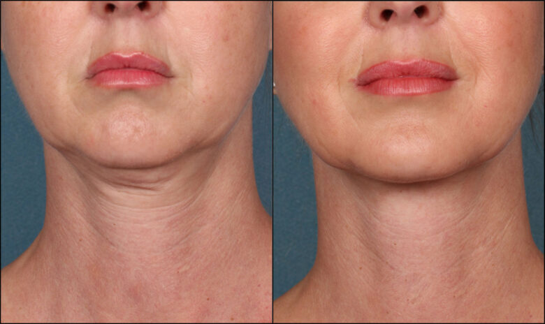 Laser Skin Tightening