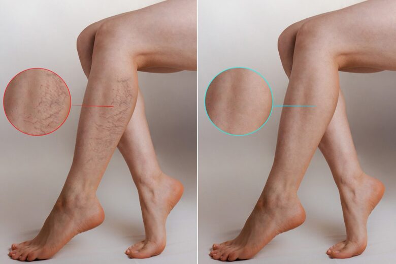 Laser Vein Treatments 