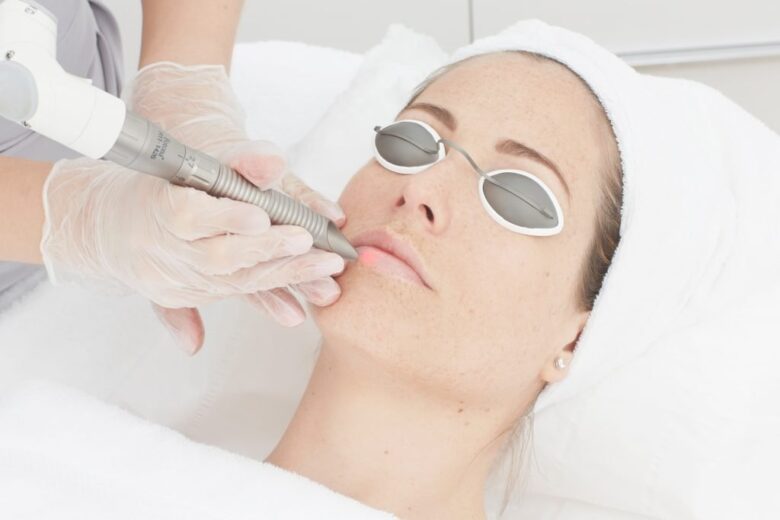 Picosecond Laser Treatment for Pigmentation