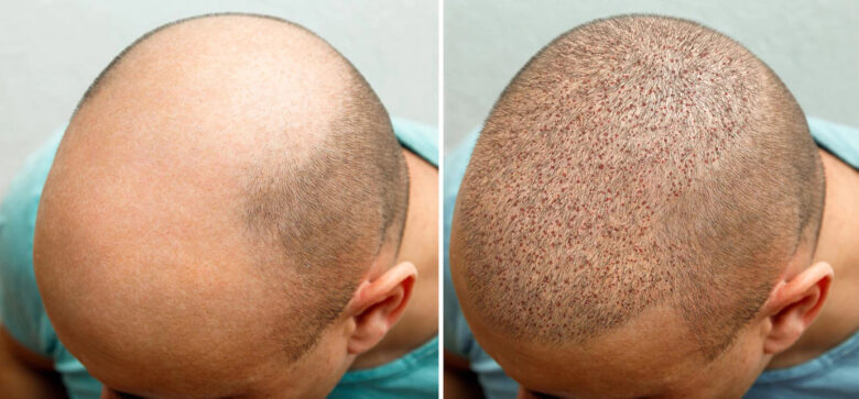 Follicular Unit Transplantation