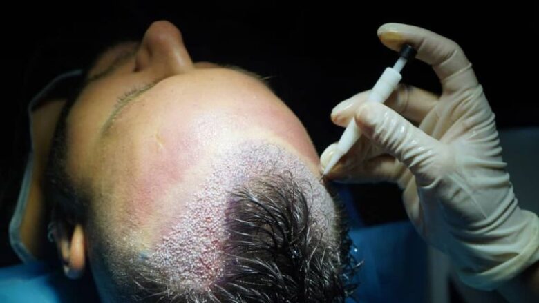 direct hair implantation