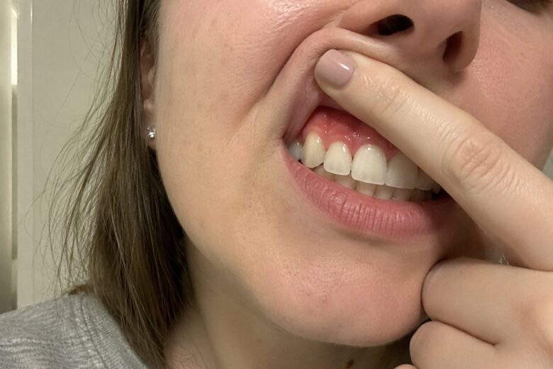 Woman checking irritated gums around her front teeth.